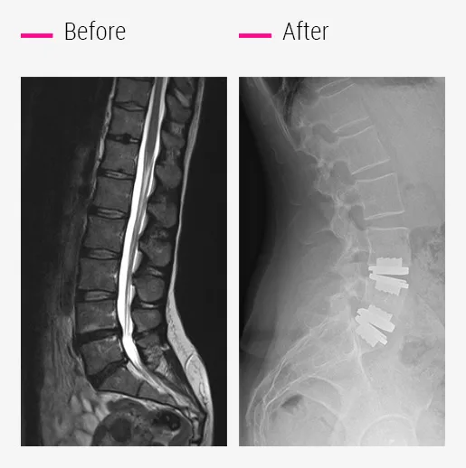 Two mobile prostheses