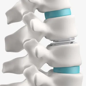Lumbar Disc Replacement